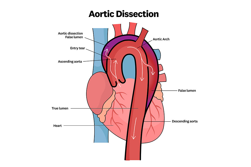 A graphic depiction of a aortic dissection with a frozen elephant trunk.